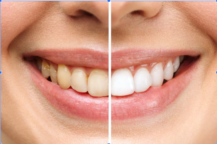 What Are the Best Teeth Whitening Colorado Springs Options?
